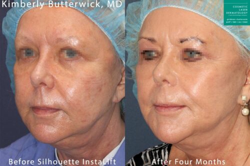 Silhouette InstaLift to rejuvenate the appearance by Dr. Butterwick. After treatment, skin and tissue is visibly lifted and patient looks more youthful, San Diego, CA.