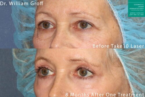 Take 10 treatment with laser resurfacing to rejuvenate the eye area by Dr. Groff. Treatment reduces appearance of lines and creates firmer, smoother skin.