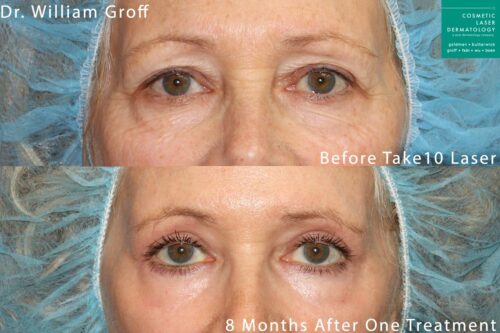 Take 10 treatment with laser resurfacing to rejuvenate the eye area by Dr. Groff. Treatment reduces appearance of lines and creates firmer, smoother skin.