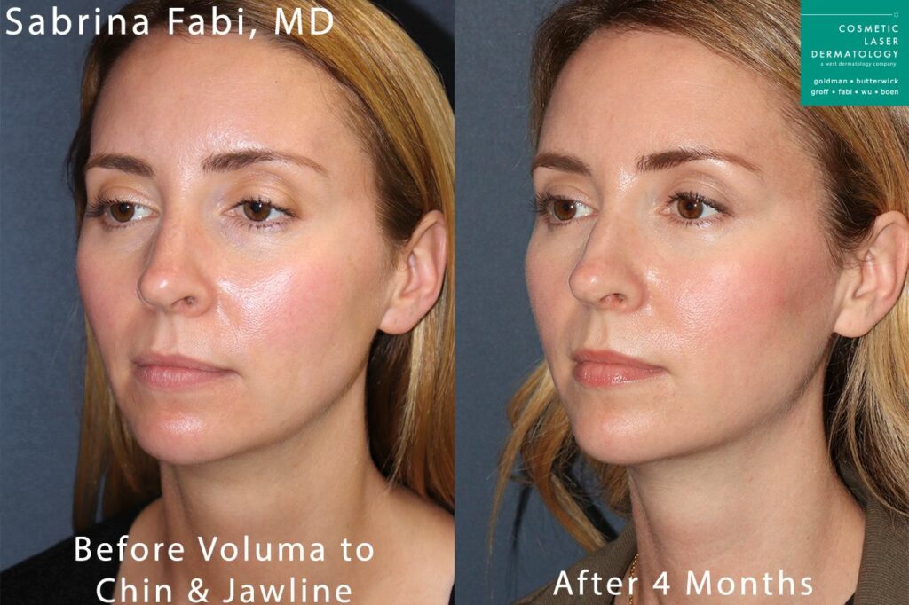 cosmetic laser dermatology Voluma to sculpt the chin and jawline before and after by Dr. Fabi San Diego CA