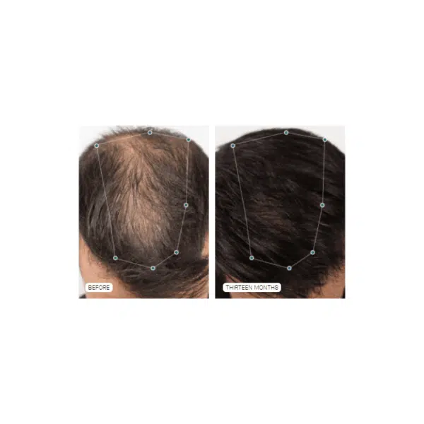 Nutrafol Hair Growth Supplement for Men - Image 3