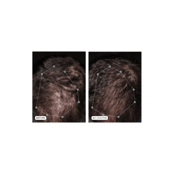 Nutrafol Hair Growth Supplement for Men - Image 4