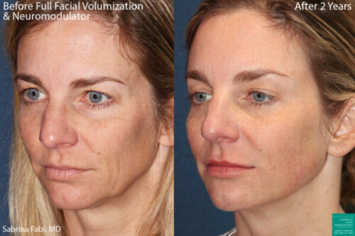 restore lost facial volume with botox in San Diego, CA