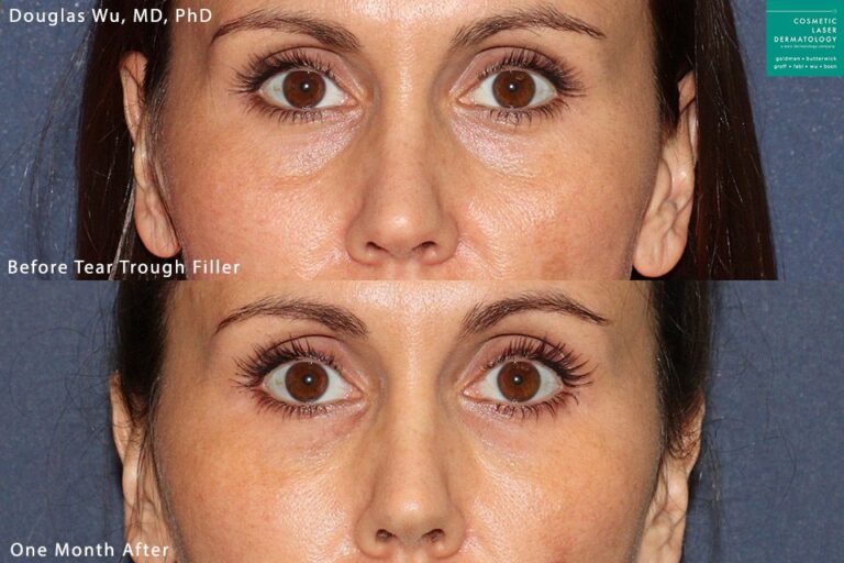 Restylane Refyne to refresh the tear troughs by Dr. Wu. After treatment, discoloration under eyes is gone and eyes look more refreshed.