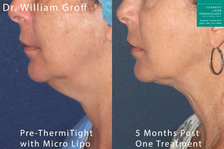 ThermiTight and microlipo to reduce submental fat under the chin by Dr. Groff. After treatment, fat is gone and neck and jawline are more contoured.