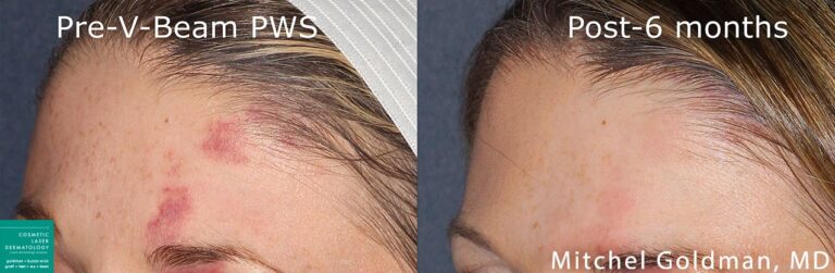 Vbeam laser to treat port wine stain by Dr. Goldman. Six months after treatment, birthmark is significantly reduced and forehead is clearer.