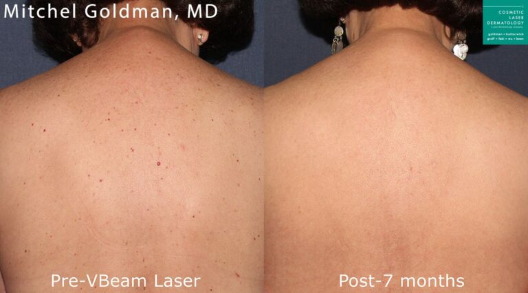 Vbeam laser to remove red spots from back by Dr. Goldman. Seven months after treatment, skin is noticeably clearer.