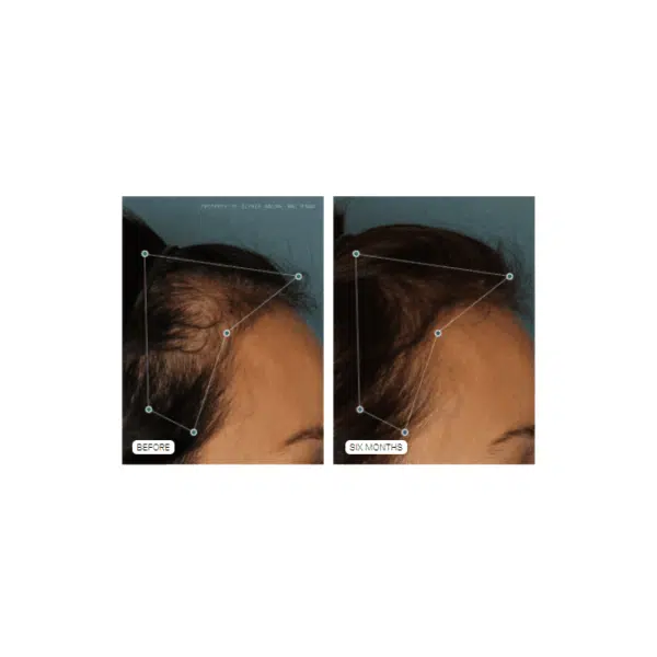 Nutrafol Hair Growth Supplement for Women - Image 3