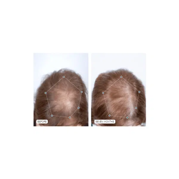 Nutrafol Hair Growth Supplement Women's Balance (ages 40+) - Image 3