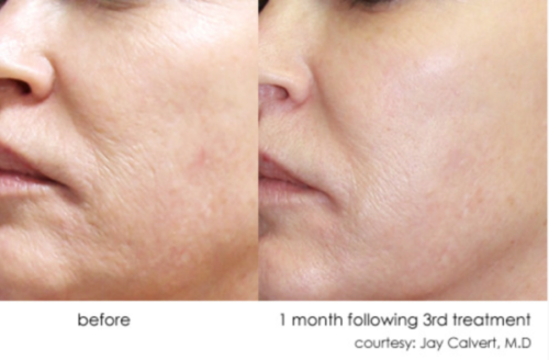 dermasweep wrinkle reduction la jolla, CA