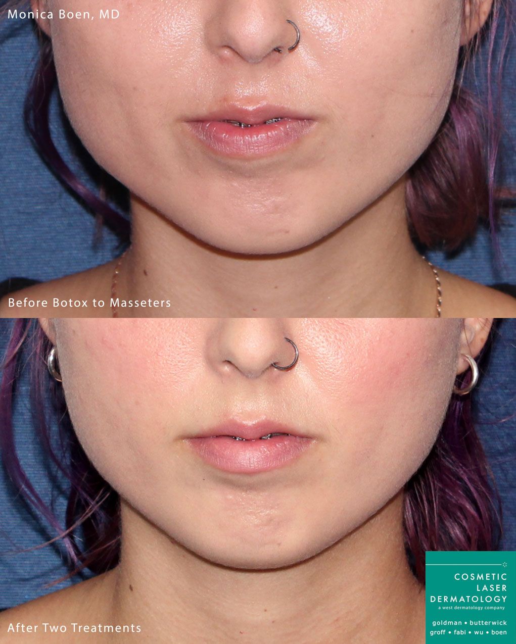 Botox for Submental Fat, Double Chin and the Journey to a Sculpted