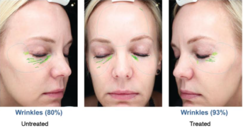 microdermabrasion undereye treatment in san diego, ca