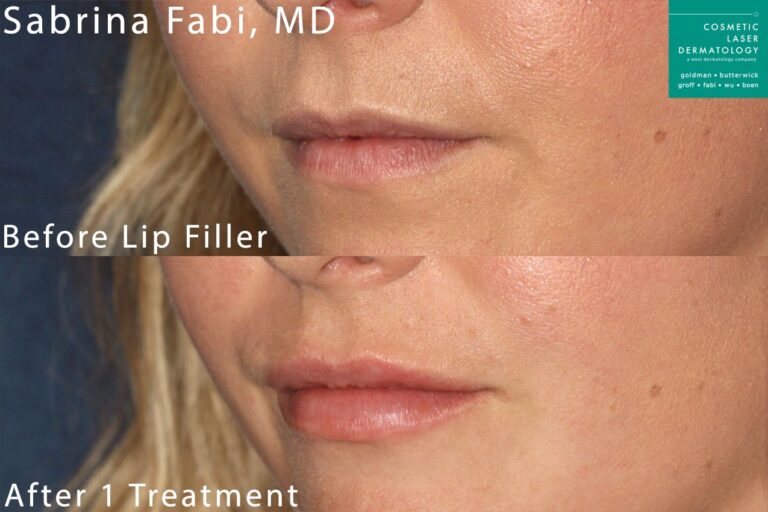 Lip filler to augment the lips by Dr. Fabi. After treatment, After a single treatment, the lips are naturally fuller and more youthful.