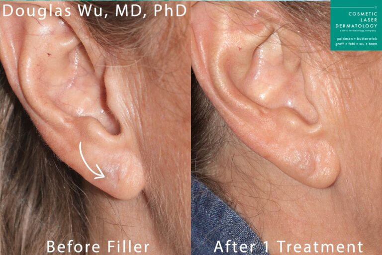 Dermal filler to plump up earlobes by Dr. Wu. Fillers adds volume and shape to the earlobe.