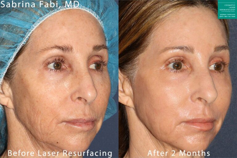 Laser resurfacing to rejuvenate the skin by Dr. Fabi. Two months after treatment, skin is smoother and looks more youthful.