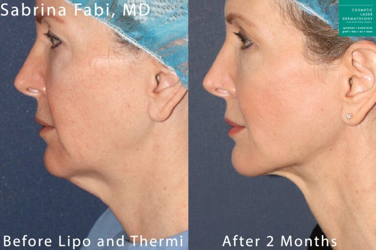 Liposuction and ThermiTIght to remove submental fat and tighten the skin by Dr. Fabi. After treatment, excess skin and fat are gone and chin is more contoured to the neck.