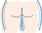 icon of buttocks used to show the cellulite treatment, San Diego, CA.