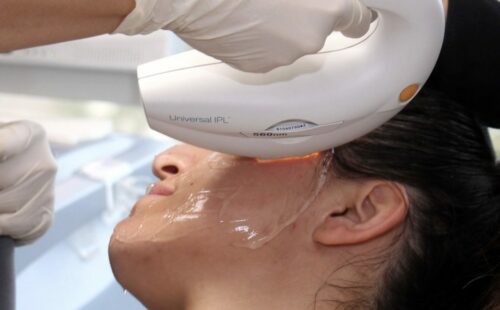 benefits of an IPL laser treatment in San Diego