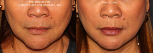 sagging skin around the mouth treatment results San Diego