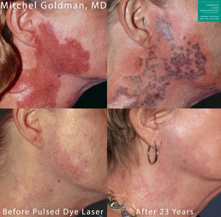 Pulse dye laser to treat port wine stain on neck. After treatment, birthmark is much less noticeable.