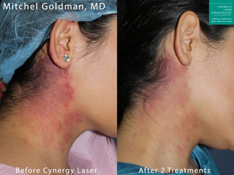 Cynergy laser to treat port wine stain on neck. After two treatments, birthmark is much less noticeable.