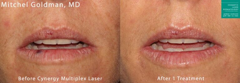 Cynergy laser to treat venous lake on lip by Dr. Goldman. After treatment, purple bump is gone.