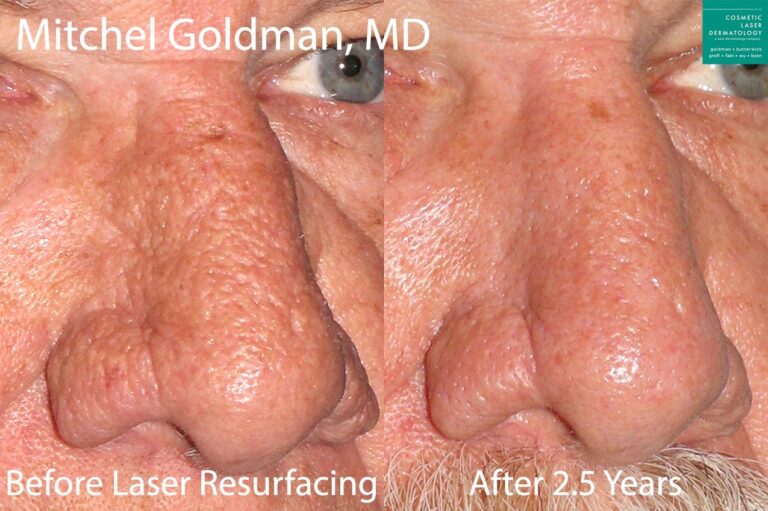 Laser Resurfacing to treat rhinophyma by Dr. Goldman. After treatment, patient's nose has a smoother texture with fewer bumps.