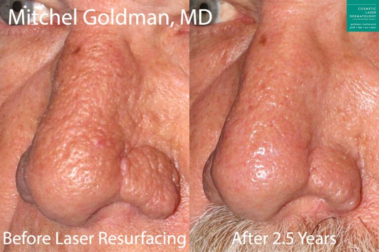 Laser Resurfacing to treat rhinophyma by Dr. Goldman. After treatment, patient's nose has a smoother texture with fewer bumps.