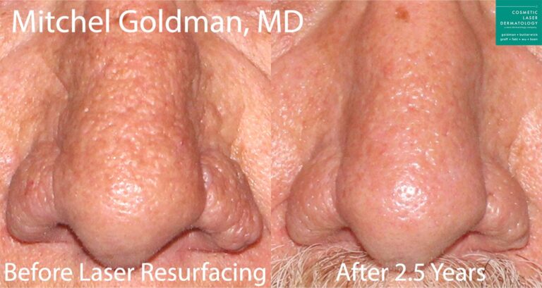 Laser Resurfacing to treat rhinophyma by Dr. Goldman. After treatment, patient's nose has a smoother texture with fewer bumps.