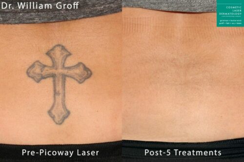 PicoWay laser treatment to remove tattoo by Dr. Groff. After 5 sessions, tattoo is gone.