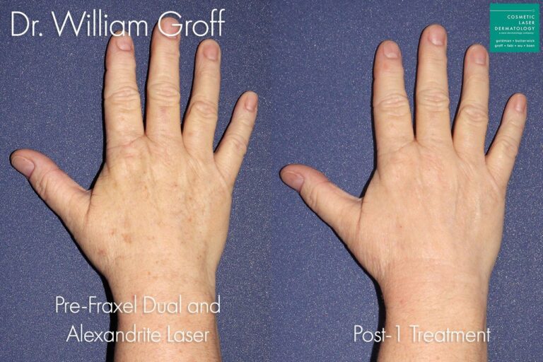 Fraxel and Alexandrite laser to rejuvenate the hands by Dr. Groff. After treatment, brown spots and sun damage are no longer visible.
