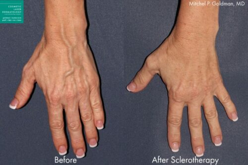 vein treatment results from our medical spa in San Diego