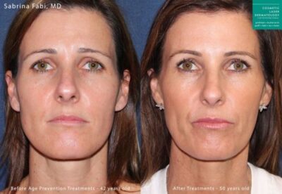 female patient before and after dermal filler treatment with redensity in San Diego