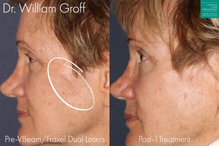 Fraxel Dual laser to treat scar on cheek by Dr. Groff. After treatment, scar is no longer visible.
