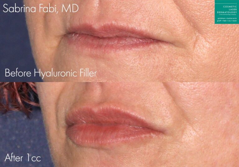 Hyaluronic acid filler to plump up the lips by Dr. Fabi. After treatment, lips are fuller and more shapely.