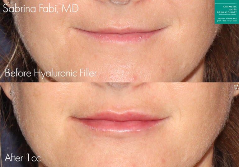 Hyaluronic acid filler to plump up the lips by Dr. Fabi. After treatment, lips are fuller and more shapely.