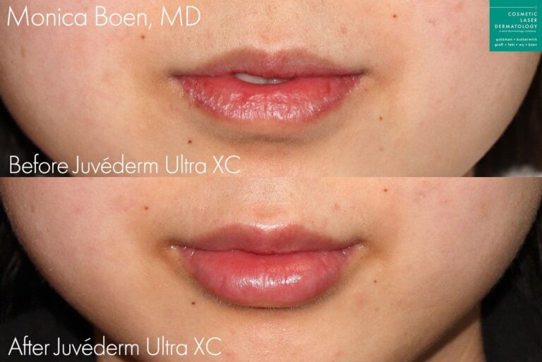 Juvederm Ultra XC to plump up the lips by Dr. Boen. After treatment, lips are fuller and more shapely.