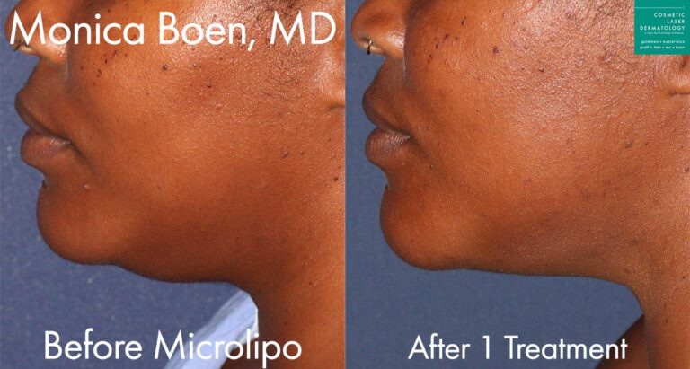 Microlipo to remove fat from underneath the chin by Dr. Boen. After the procedure, patient has more definition along the jawline and a smoother transition from the chin to the neck.