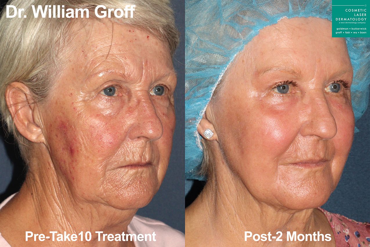 clderm take10 treatment before and after san diego ca