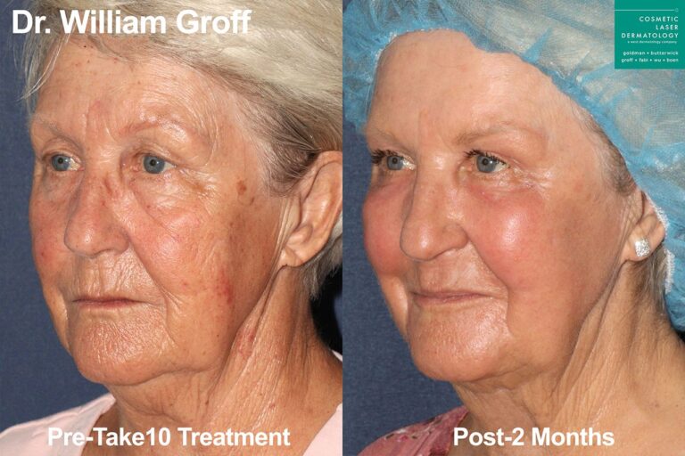 Take 10 treatment with laser resurfacing to rejuvenate the entire face by Dr. Groff. Treatment reduces appearance of lines and creates firmer, smoother skin.