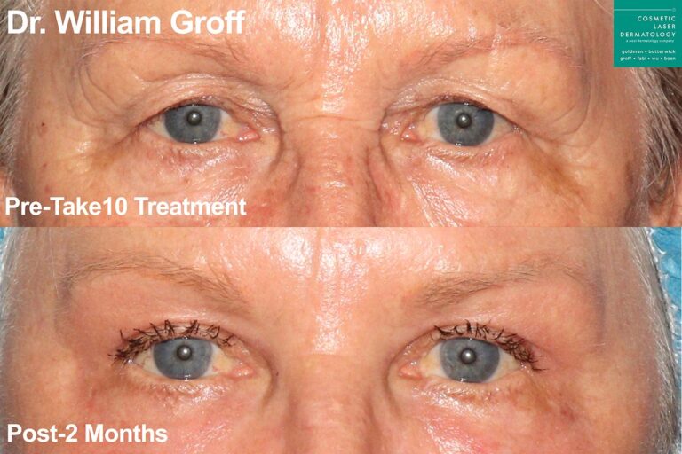 Take 10 treatment with laser resurfacing to rejuvenate the area around the eyes by Dr. Groff. Treatment reduces appearance of lines and creates firmer, smoother skin.