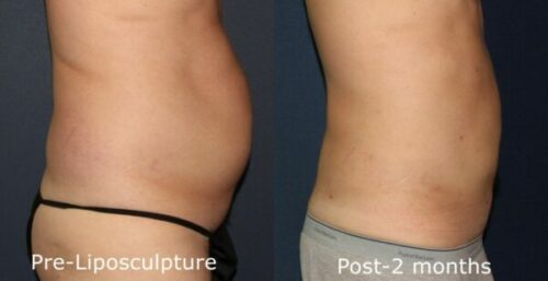 before and after results from a Cool³ body contouring treatment in San Diego, CA