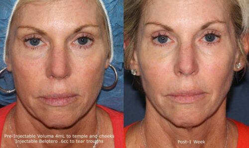 liquid facelift with Botox results in San Diego