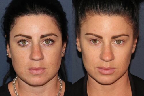 preventative botox results in san diego,CA