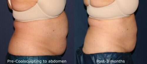 before and after image of Cool³ body contouring results from patient in San Diego