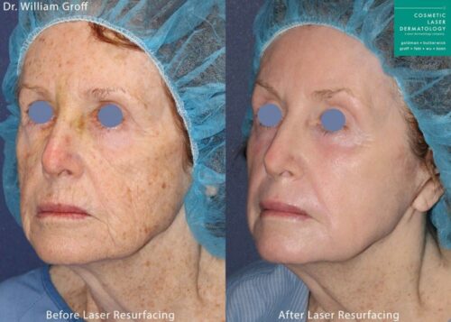 Take10 laser treatment result in San Diego