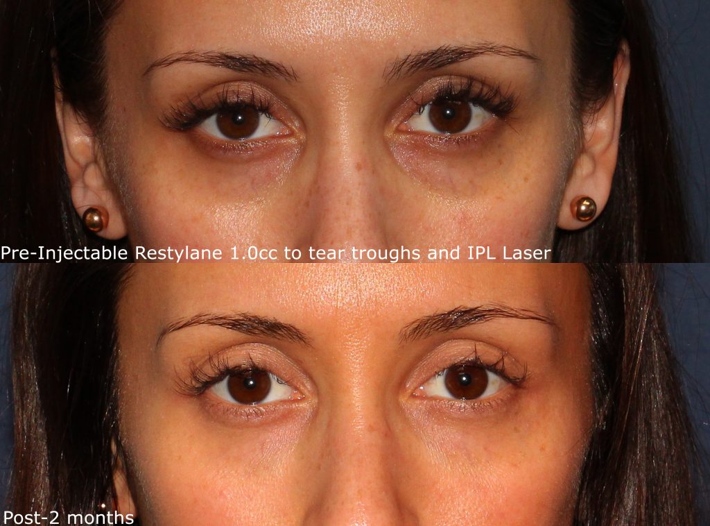 Eye Rejuvenation Cosmetic Laser Dermatology Skin Specialists in