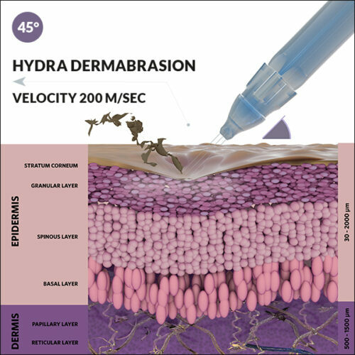 illustration of how the jetpeel procedure at our San Diego medical spa rejuvenates the skin