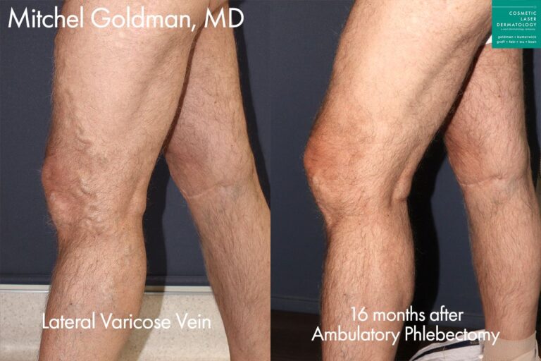 Ambulatory phlebectomy to remove varicose veins by Dr. Goldman. After treatment, bulging veins are gone.