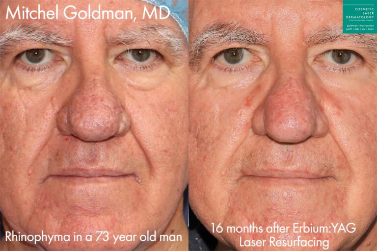 Erbium laser to treat rhinophyma by Dr. Goldman. After treatment nose is smoother and shape is improved.